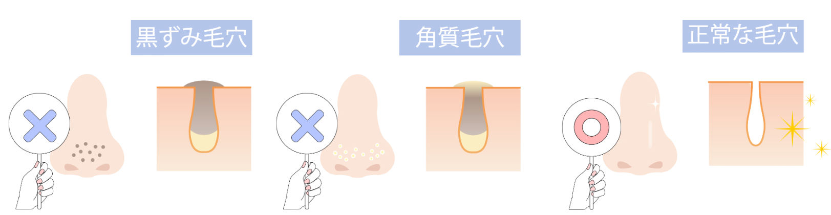 黒ずみ毛穴→「×」角質毛穴→「×」正常な毛穴→「⚪︎」